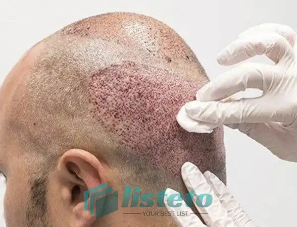 مراقبت های پس از کاشت مو
